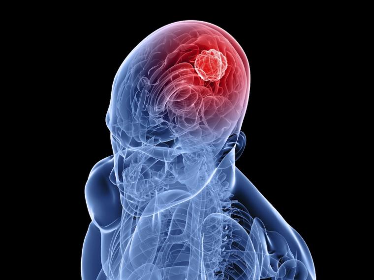 Estudio reciente: el CBD puede detener el cáncer de cerebro en humanos y perros